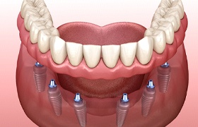 Model of dental implant-retained dentures in DeLand