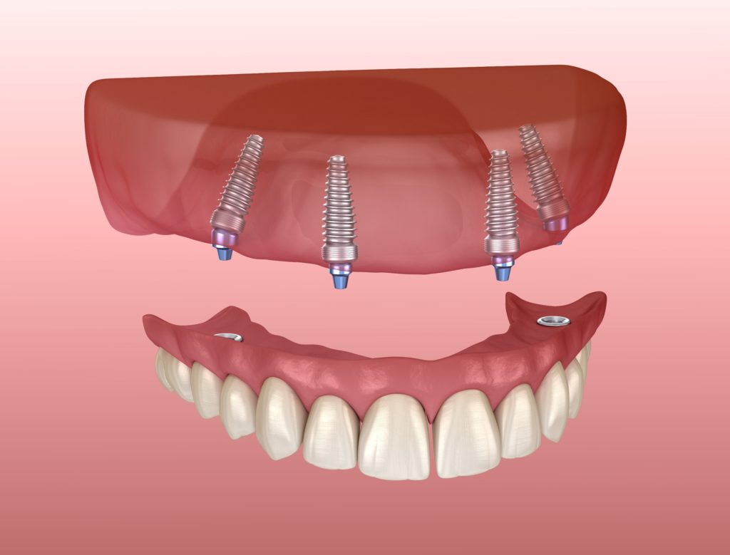 does-adding-dental-implants-to-dentures-really-make-a-difference